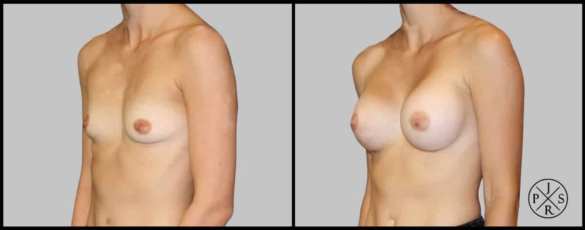 Breast Augmentation Before & After Image