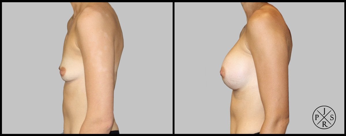 Breast Augmentation Before & After Image