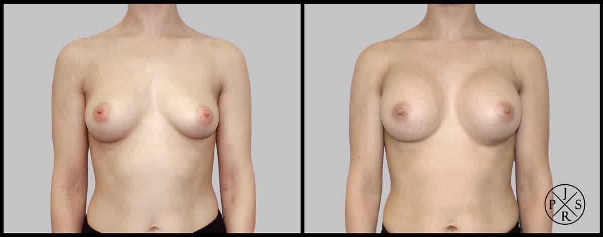 Breast Augmentation Before & After Image