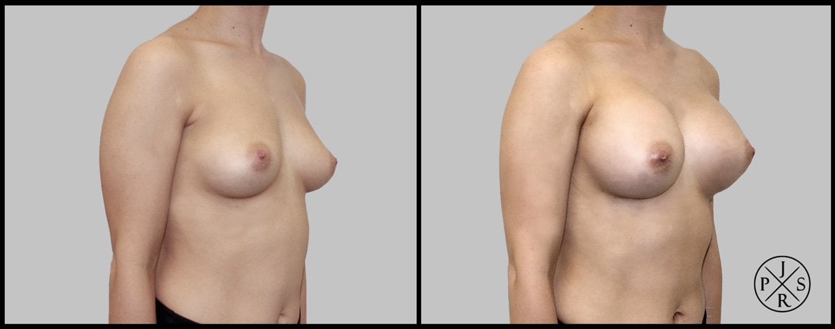 Breast Augmentation Before & After Image