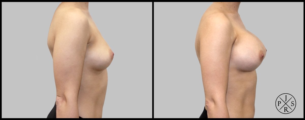 Breast Augmentation Before & After Image