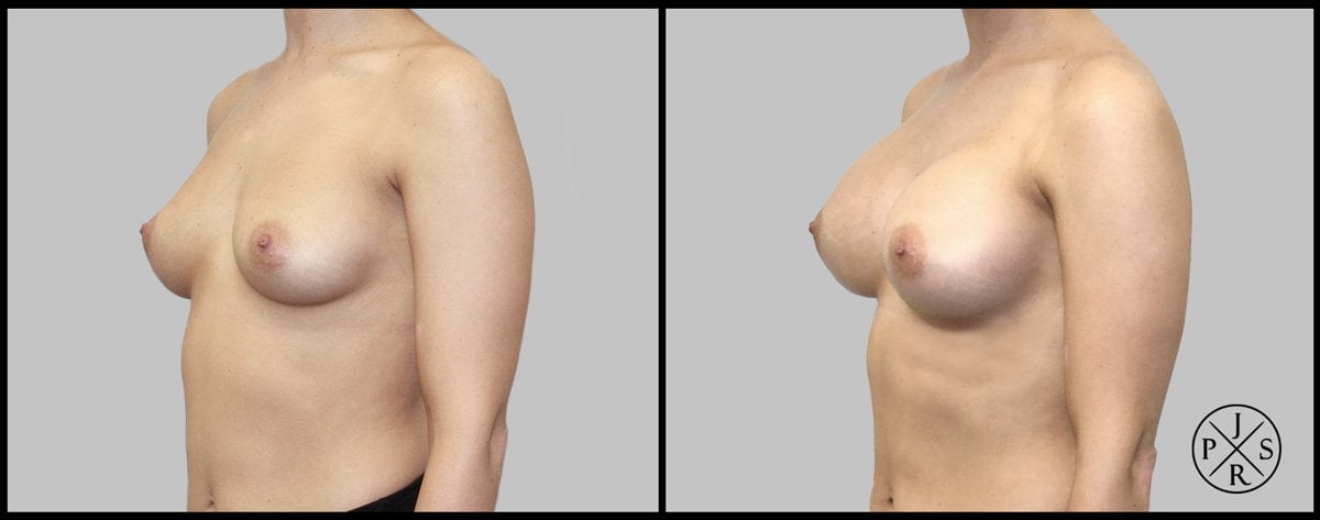 Breast Augmentation Before & After Image