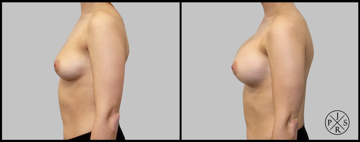 Breast Augmentation Before & After Image