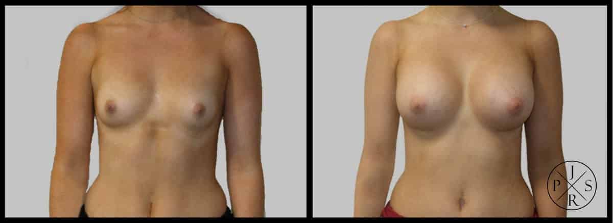 Breast Augmentation Before & After Image