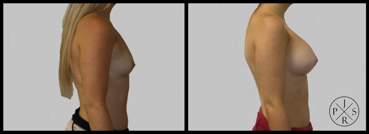 Breast Augmentation Before & After Image