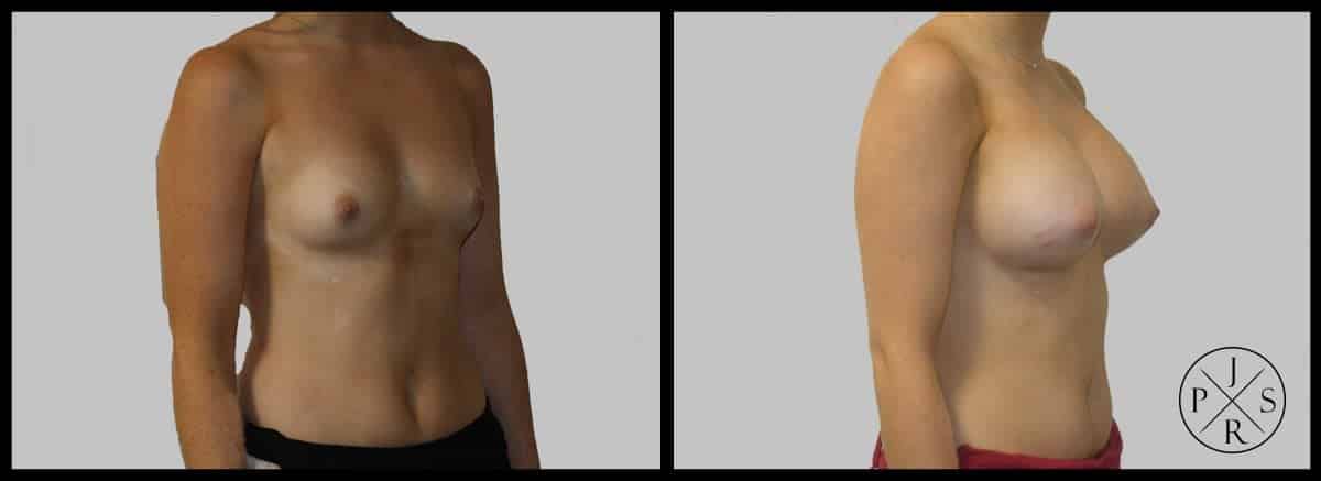 Breast Augmentation Before & After Image