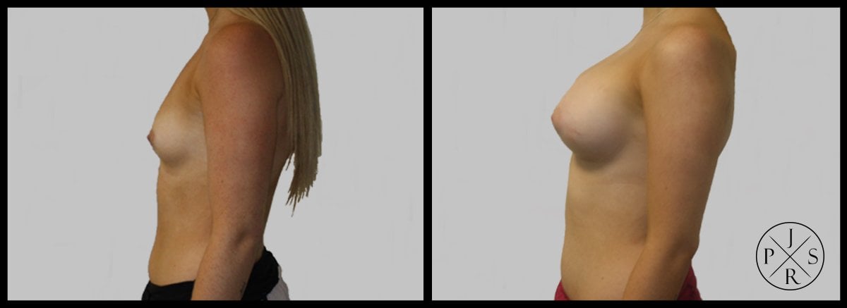 Breast Augmentation Before & After Image