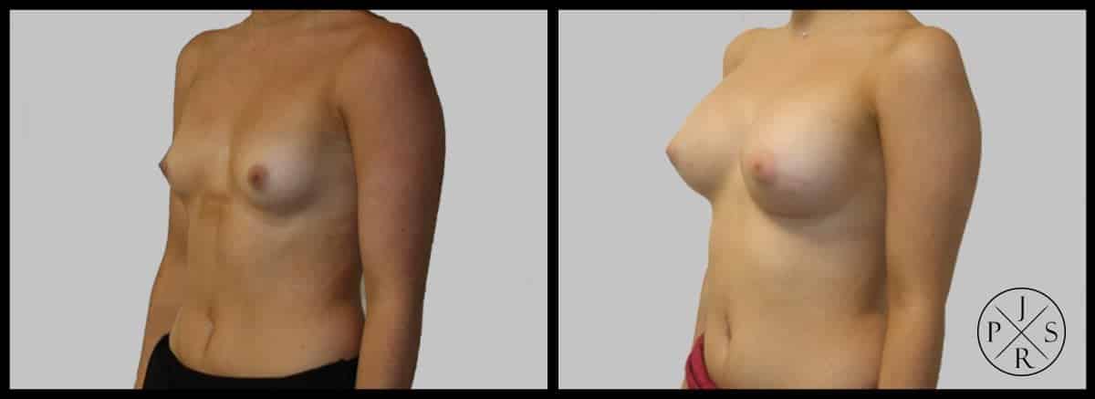 Breast Augmentation Before & After Image