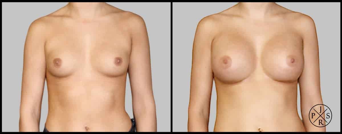 Breast Augmentation Before & After Image