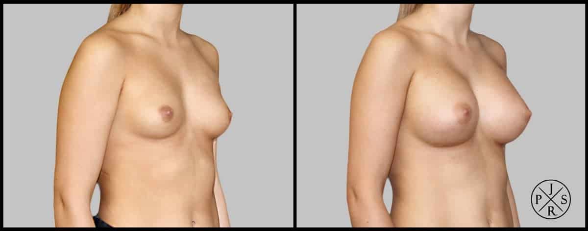 Breast Augmentation Before & After Image