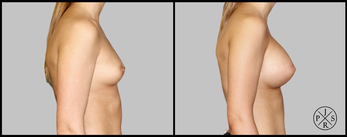 Breast Augmentation Before & After Image