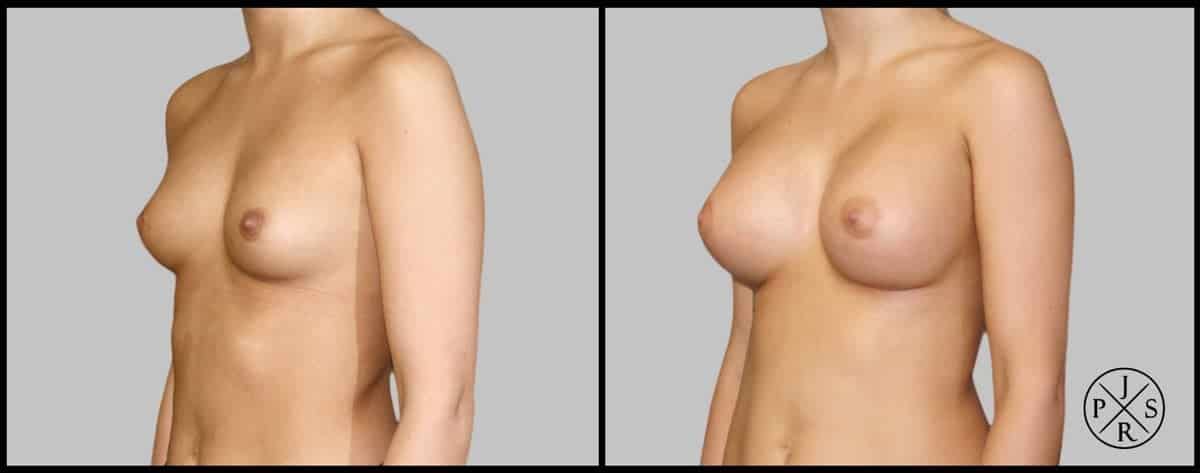 Breast Augmentation Before & After Image