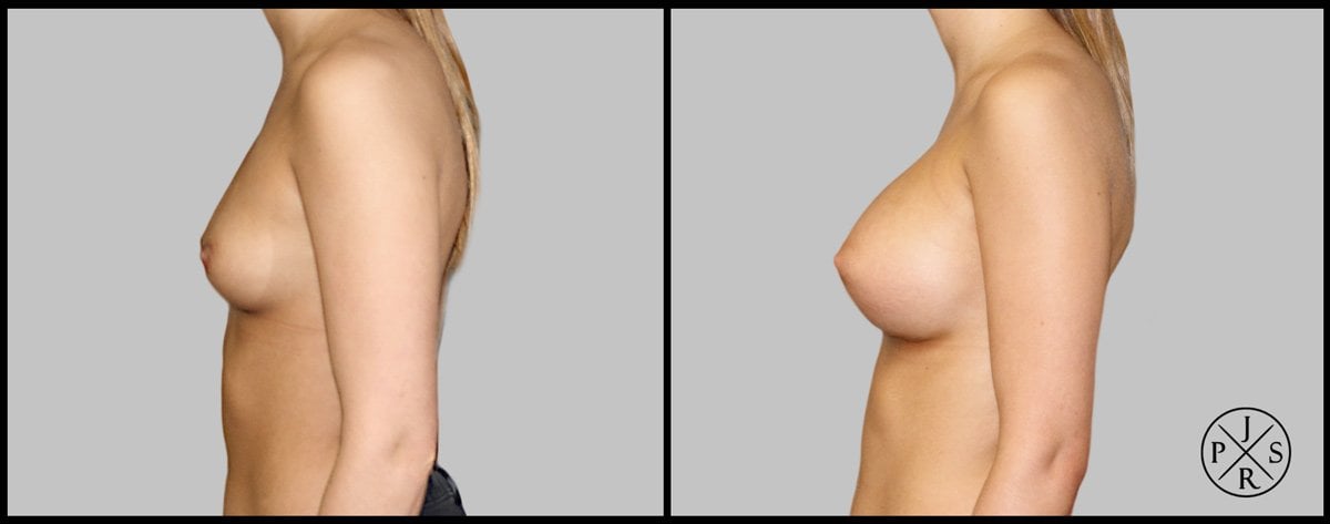 Breast Augmentation Before & After Image