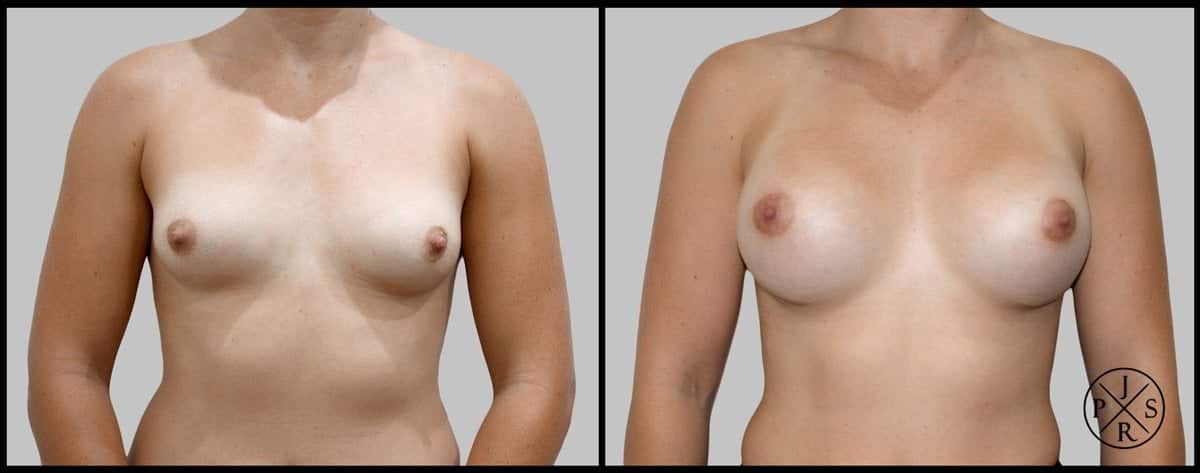 Breast Augmentation Before & After Image