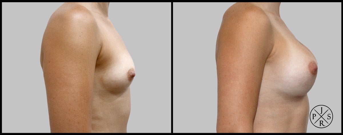 Breast Augmentation Before & After Image