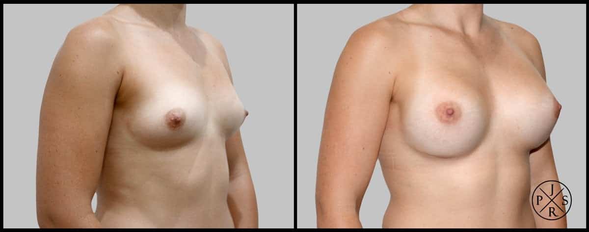 Breast Augmentation Before & After Image