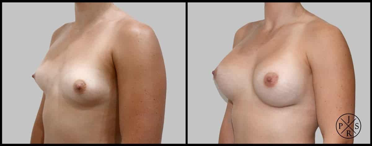 Breast Augmentation Before & After Image