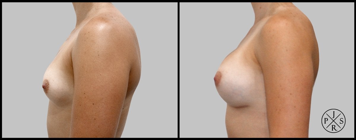 Breast Augmentation Before & After Image