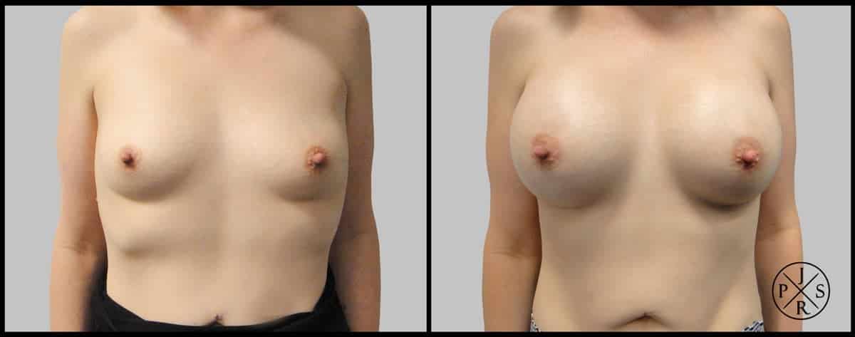 Breast Augmentation Before & After Image