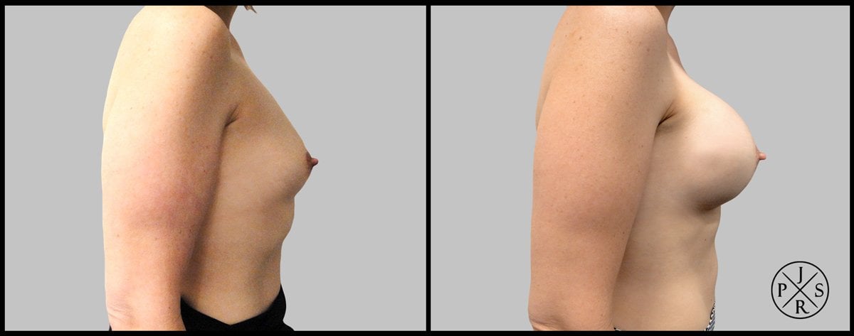 Breast Augmentation Before & After Image