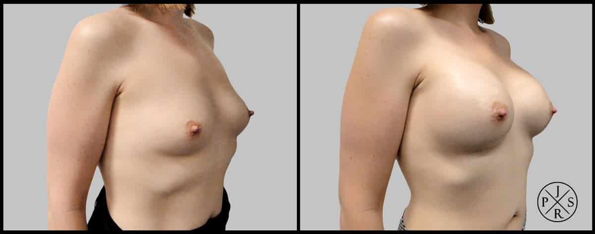 Breast Augmentation Before & After Image