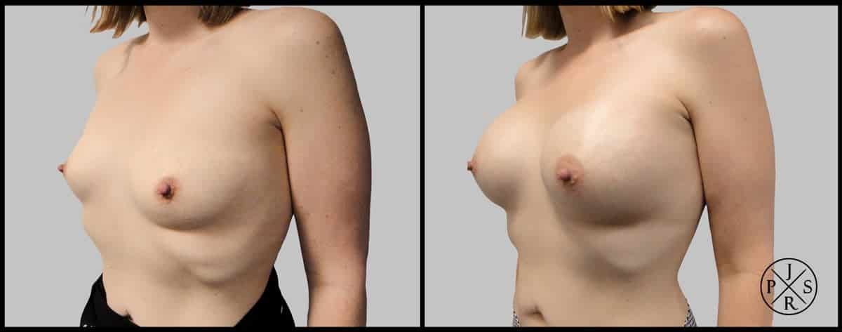 Breast Augmentation Before & After Image