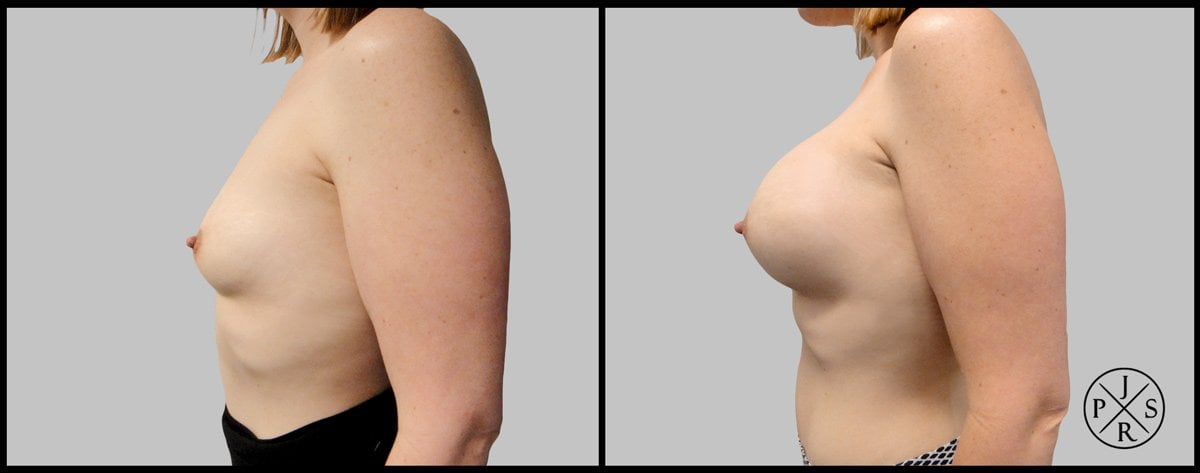 Breast Augmentation Before & After Image