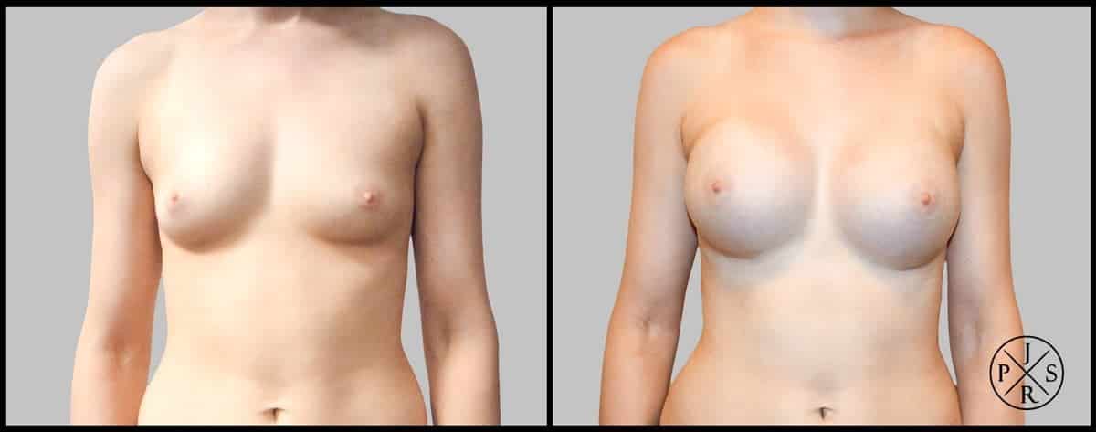 Breast Augmentation Before & After Image