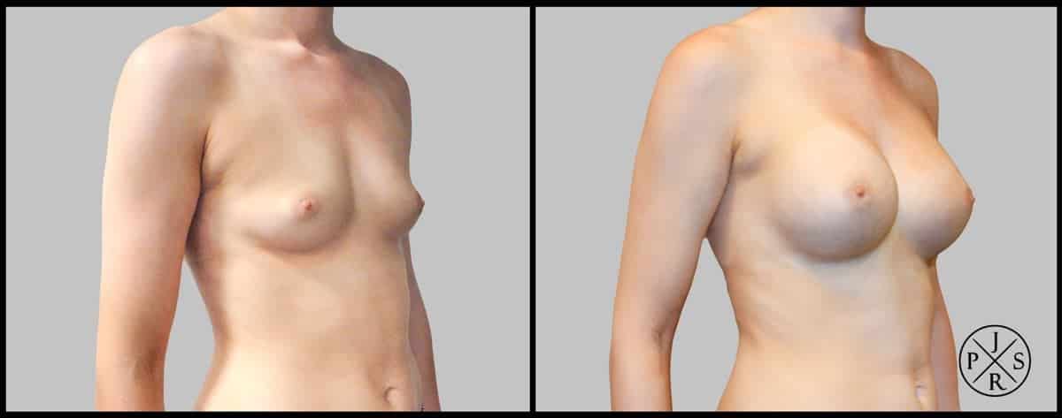 Breast Augmentation Before & After Image