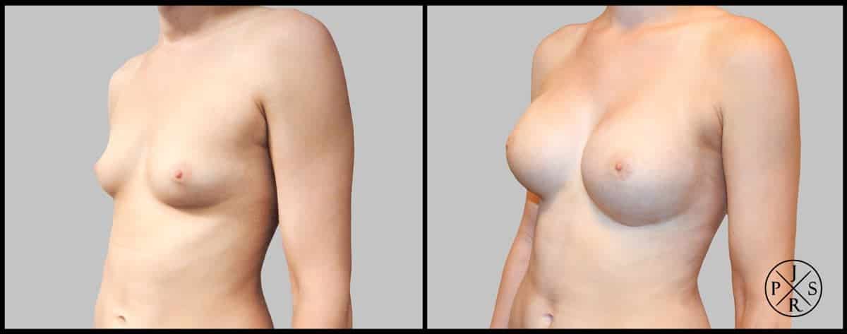 Breast Augmentation Before & After Image