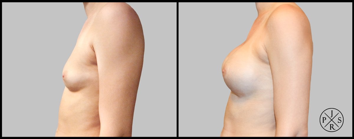 Breast Augmentation Before & After Image