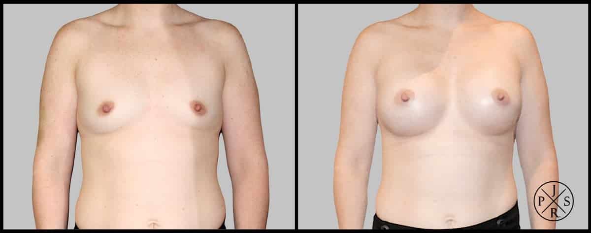 Breast Augmentation Before & After Image