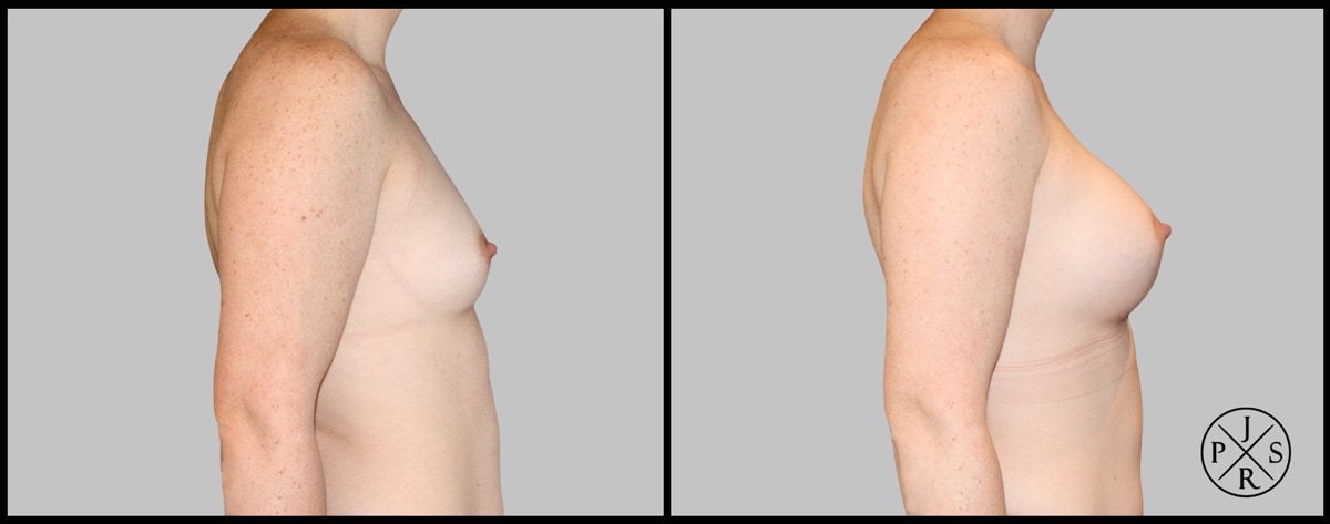 Breast Augmentation Before & After Image