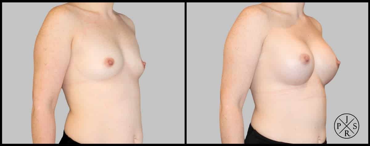 Breast Augmentation Before & After Image