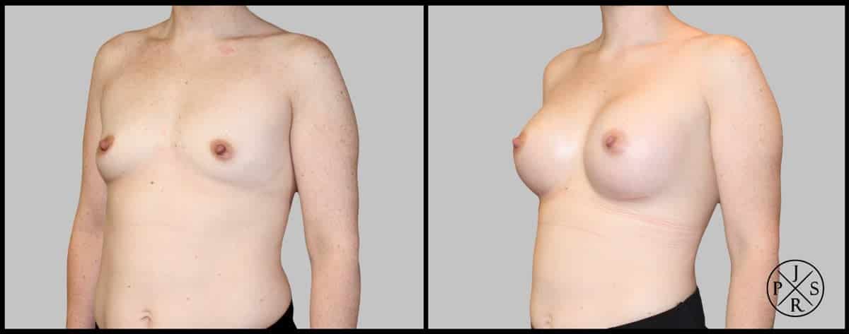 Breast Augmentation Before & After Image