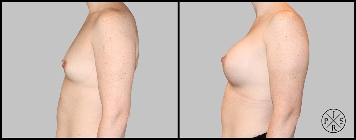 Breast Augmentation Before & After Image