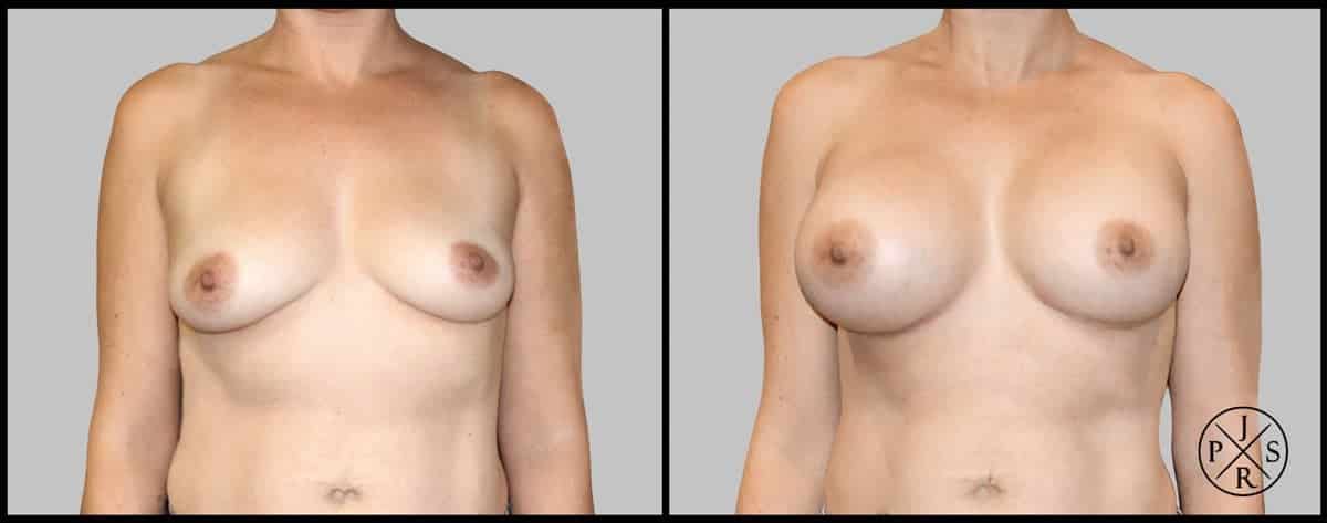 Breast Augmentation Before & After Image