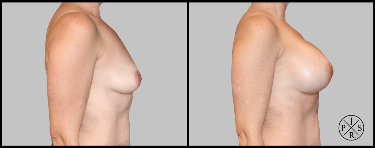 Breast Augmentation Before & After Image