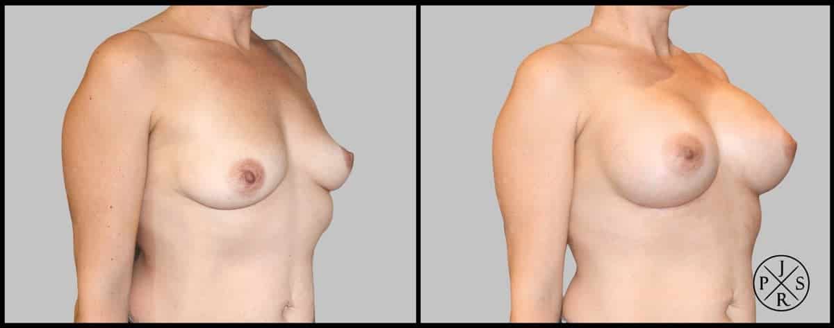 Breast Augmentation Before & After Image