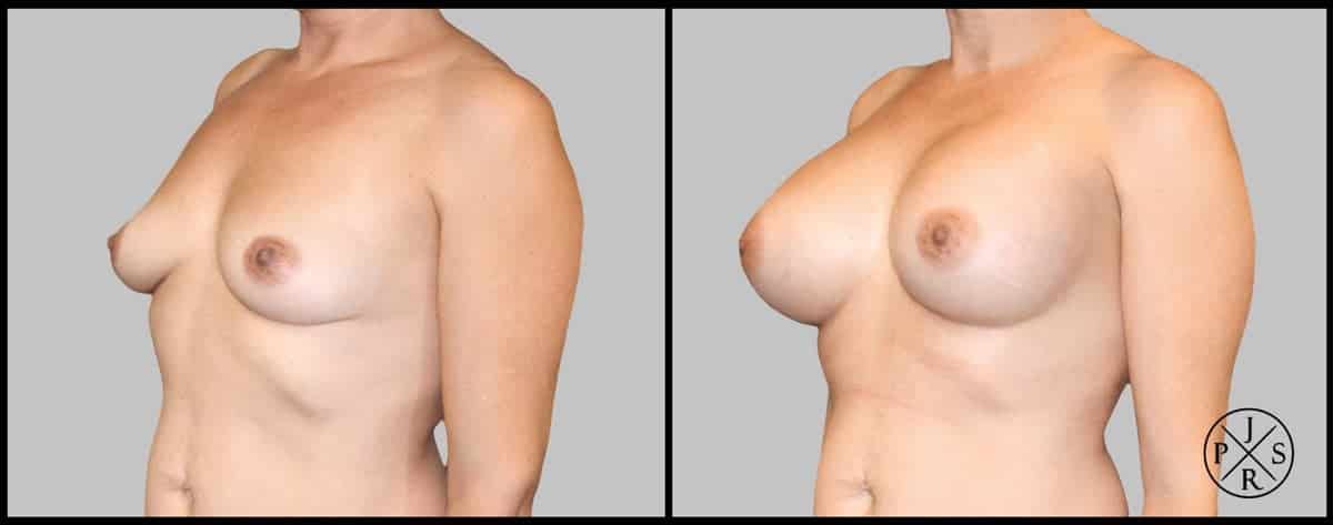 Breast Augmentation Before & After Image