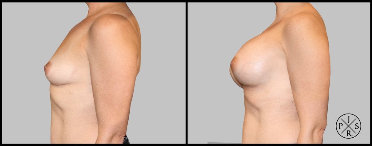 Breast Augmentation Before & After Image