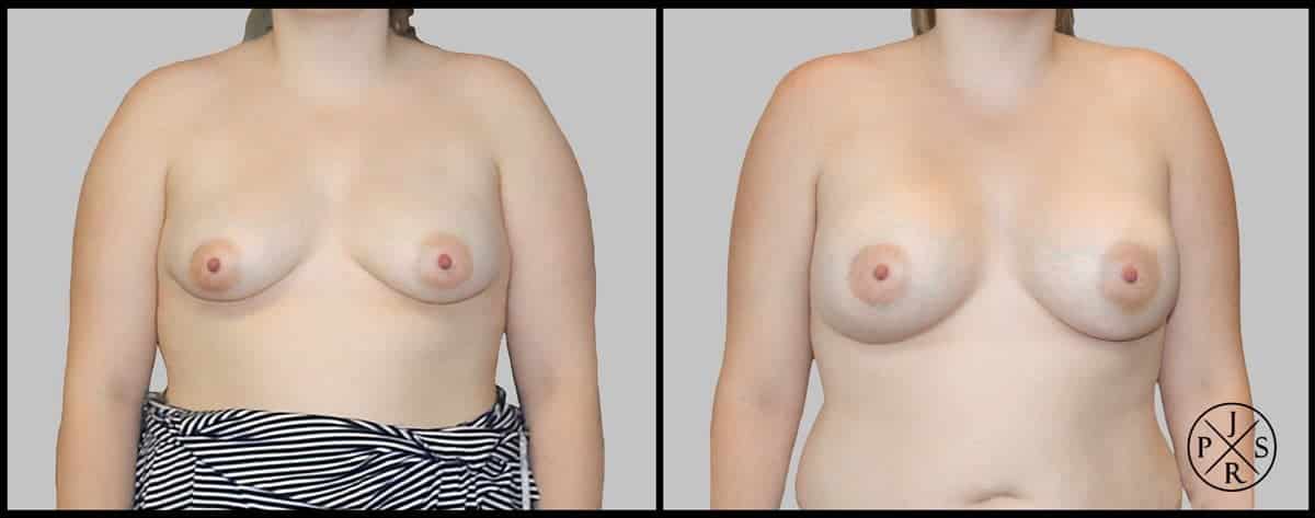 Breast Augmentation Before & After Image