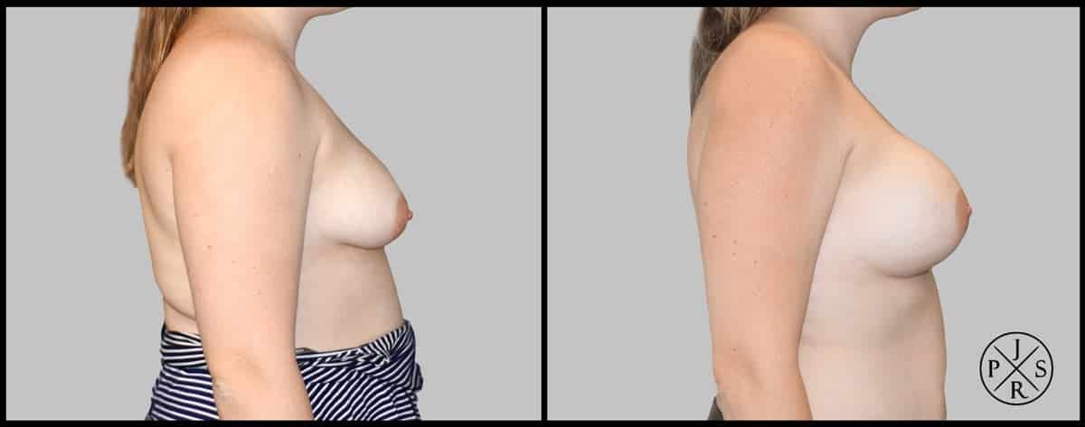 Breast Augmentation Before & After Image