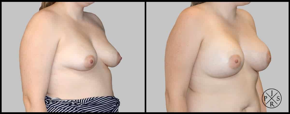 Breast Augmentation Before & After Image