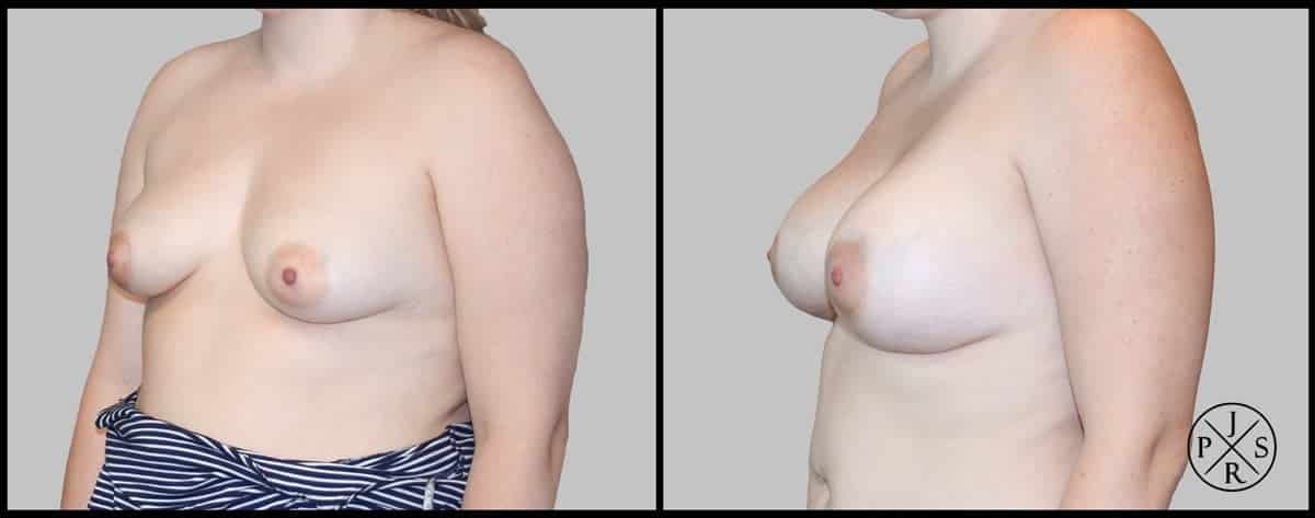 Breast Augmentation Before & After Image