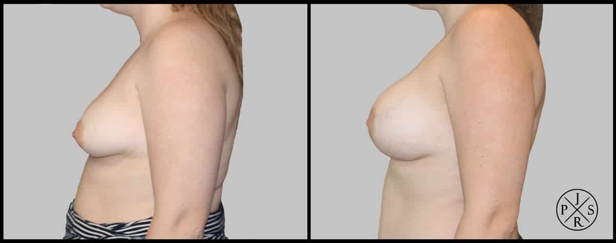 Breast Augmentation Before & After Image