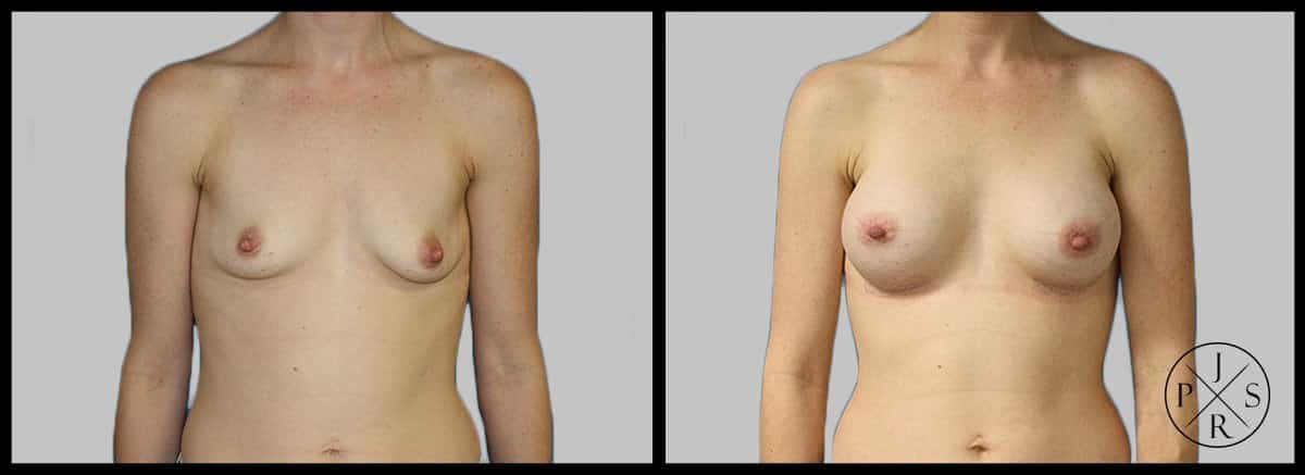 Breast Augmentation Before & After Image