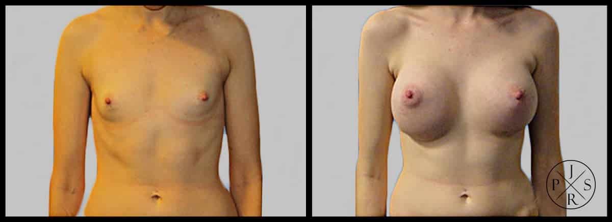 Breast Augmentation Before & After Image