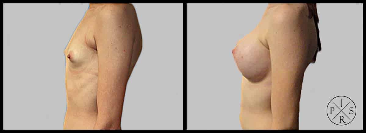 Breast Augmentation Before & After Image