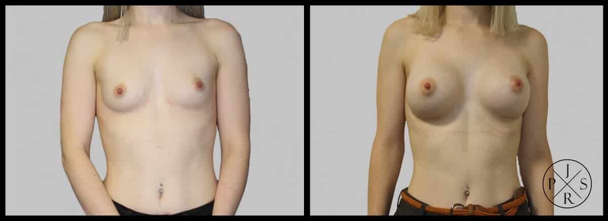 Breast Augmentation Before & After Image